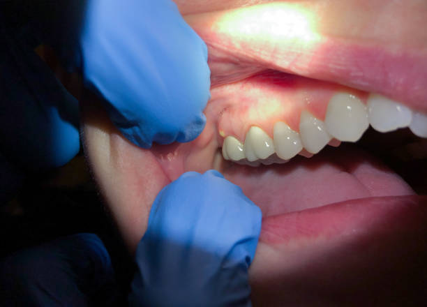 Best Dentist for Tooth Abscess  in New Town, ND